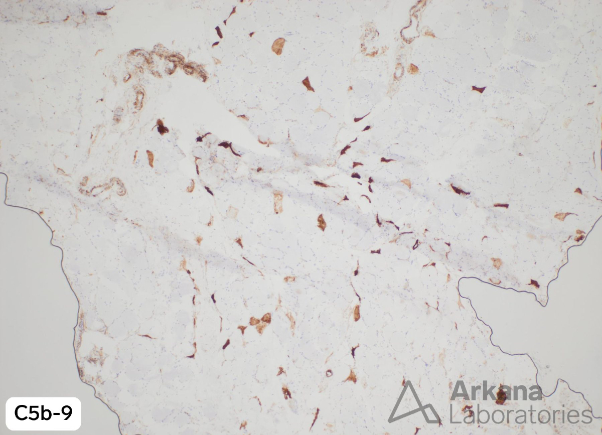 arkanalabs's tweet photo. Here is the clinical history for a 71 year old man with proximal weakness:
- Past medical history: advanced esophageal adenocarcinoma status post radiation and chemo/immunotherapy with immune mediated hepatitis, and moderate alcohol use.
- Medications: nivolumab, FOLFOX chemotherapy (fluorouracil, folinic acid, and oxaliplatin), and prednisone.
- Physical exam: strength: bilateral mild proximal upper and severe lower extremity weakness; reflexes: silent in bilateral lower extremities; sensation decreased in feet and hands; no mandatory.
- Imaging: White matter volume loss and microvascular injury; no definite cord or neural foraminal compression.
Lab results: highest CK 20,000 currently trending downward.
What agent is primarily responsible based on the reference images?
A. Nivolumab
B. Fluorouracil
C. Oxaliplatin
D. Prednisone
#NeuroNotes #neuropath #pathology #neuromuscularpath