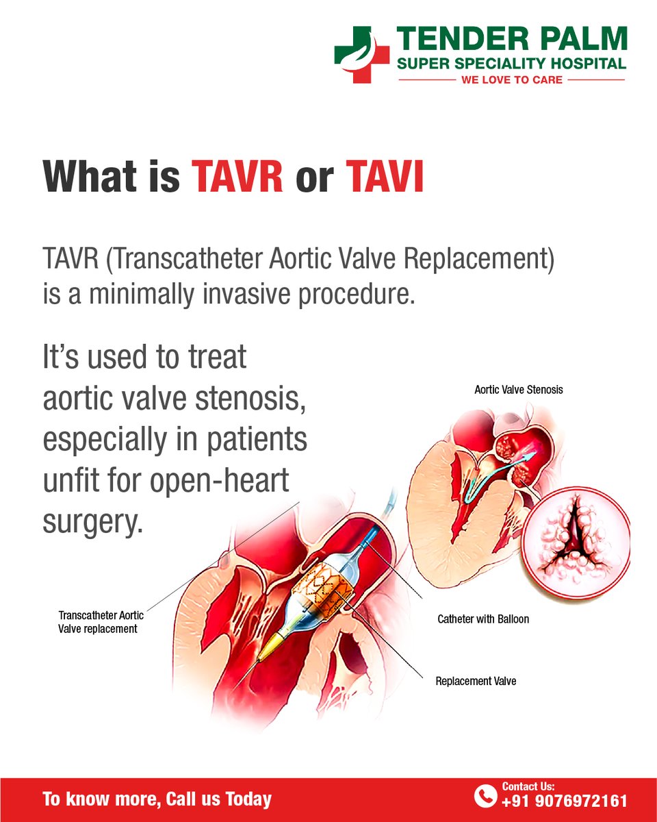 TAVR (or TAVI) – A Lifesaving, Minimally Invasive Heart Valve Replacement for Patients Who Cannot Undergo Open-Heart Surgery. Now Available at Tender Palm Hospital, Lucknow!