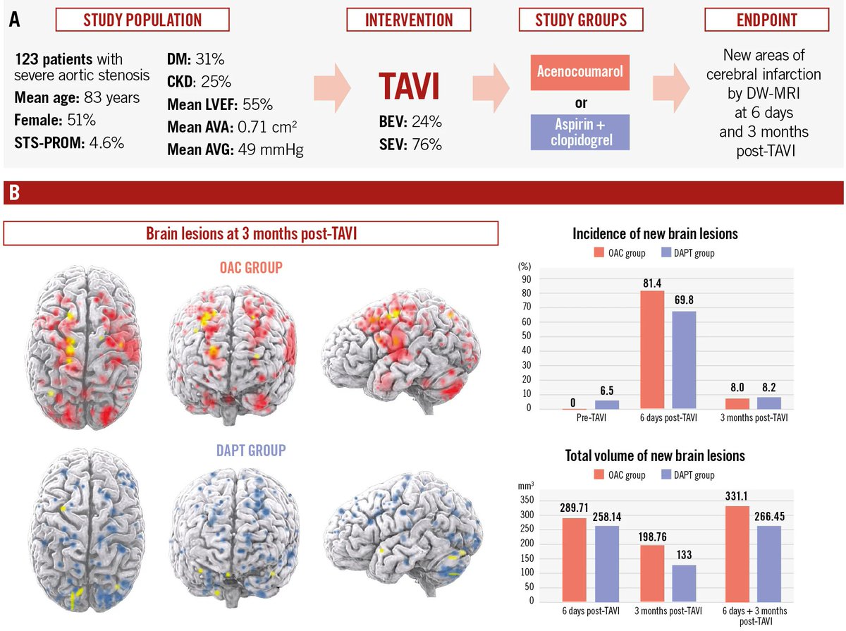 DFCapodanno's tweet image. In the randomized, open-label AUREA trial, an OAC strategy for 3 months post-TAVI did not show any benefit over an antiplatelet strategy in preventing cerebral microembolism in patients without an indication for OAC. Patients treated with DAPT showed a lower mean volume of brain…