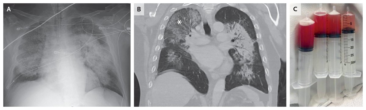 Images in Clinical Medicine: Diffuse Alveolar Hemorrhage in ANCA-Associated Vasculitis nej.md/3TcS1Ro 

#Pulmonology #CriticalCare