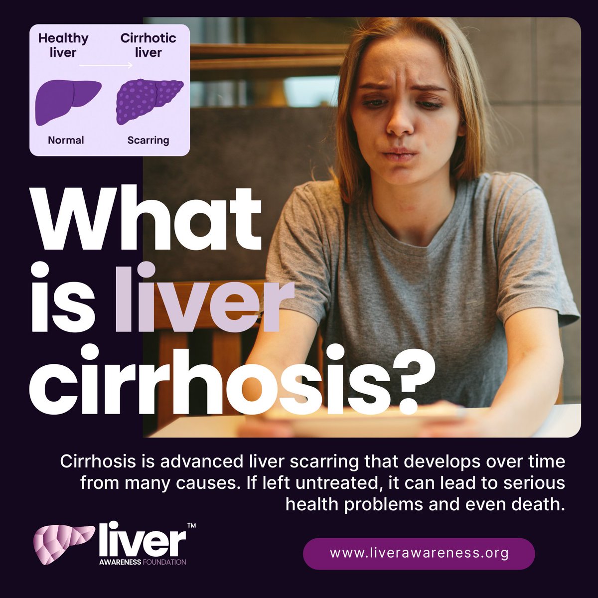 LiverAwareness's tweet image. Cirrhosis develops slowly and often without symptoms.
It’s caused by long-term liver damage and can lead to serious health problems — even death.
The sooner young people know, the sooner they can act.
Mind Your Liver. It Needs You.™
#Cirrhosis #EarlyDetection #YouthHealth