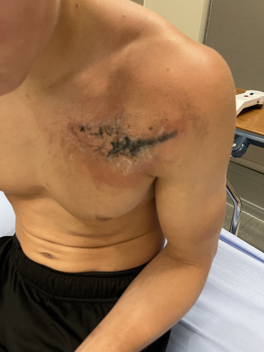 MrAdamAp's tweet image. Nothing puts life in perspective faster than near tragedy. Someone&apos;s firework display tipped over and hit my kid in the chest...he threw it off his chest before it exploded.

Life is too short. 

Reach out to your family and friends. Enjoy the day.