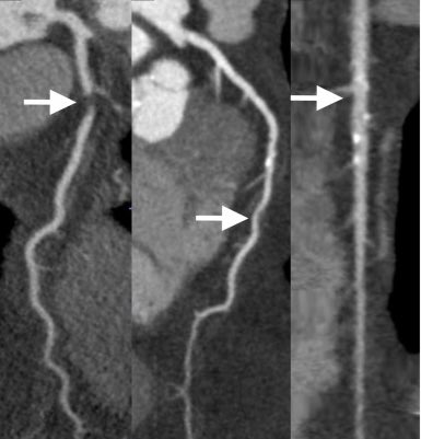 Tyler C. Miller, MD (@tcmillermd) on Twitter photo JUST ACCEPTED: Check out our new article in <a href="/journalCCT/">Journal of Cardiovascular CT</a> involving clinical outcomes in patients with discreet NCP and low CAC 0-100 from our high CV risk region of WV:
Thank you <a href="/WVUHeart/">Jim Mills</a>, <a href="/HamiraniYasmin/">Yasmin S. Hamirani, MD</a>, <a href="/EHendricks_MD/">Emily Hendricks</a>, <a href="/SeherBerzingi/">Seher Berzingi, MD</a>, <a href="/ImWvu/">WVU IM Residency</a>!
🔗 nam04.safelinks.protection.outlook.com/?url=https%3A%… JUST ACCEPTED: Check out our new article in <a href="/journalCCT/">Journal of Cardiovascular CT</a> involving clinical outcomes in patients with discreet NCP and low CAC 0-100 from our high CV risk region of WV:
Thank you <a href="/WVUHeart/">Jim Mills</a>, <a href="/HamiraniYasmin/">Yasmin S. Hamirani, MD</a>, <a href="/EHendricks_MD/">Emily Hendricks</a>, <a href="/SeherBerzingi/">Seher Berzingi, MD</a>, <a href="/ImWvu/">WVU IM Residency</a>!
🔗 nam04.safelinks.protection.outlook.com/?url=https%3A%…