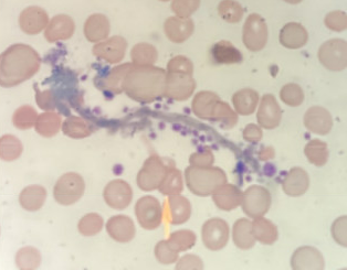 WilliamAird4's tweet photo. PSEUDOTHROMBOCYTOPENIA - A RARE CAUSE

65 yo M with platelet count 45K.  Peripheral smear showed platelets clinging to fibrin strands due to a pre-analytical artifact from in vitro platelet-fibrin interaction.

Always confirm a low platelet count with a smear review! https://t.co/t7suOEX71B