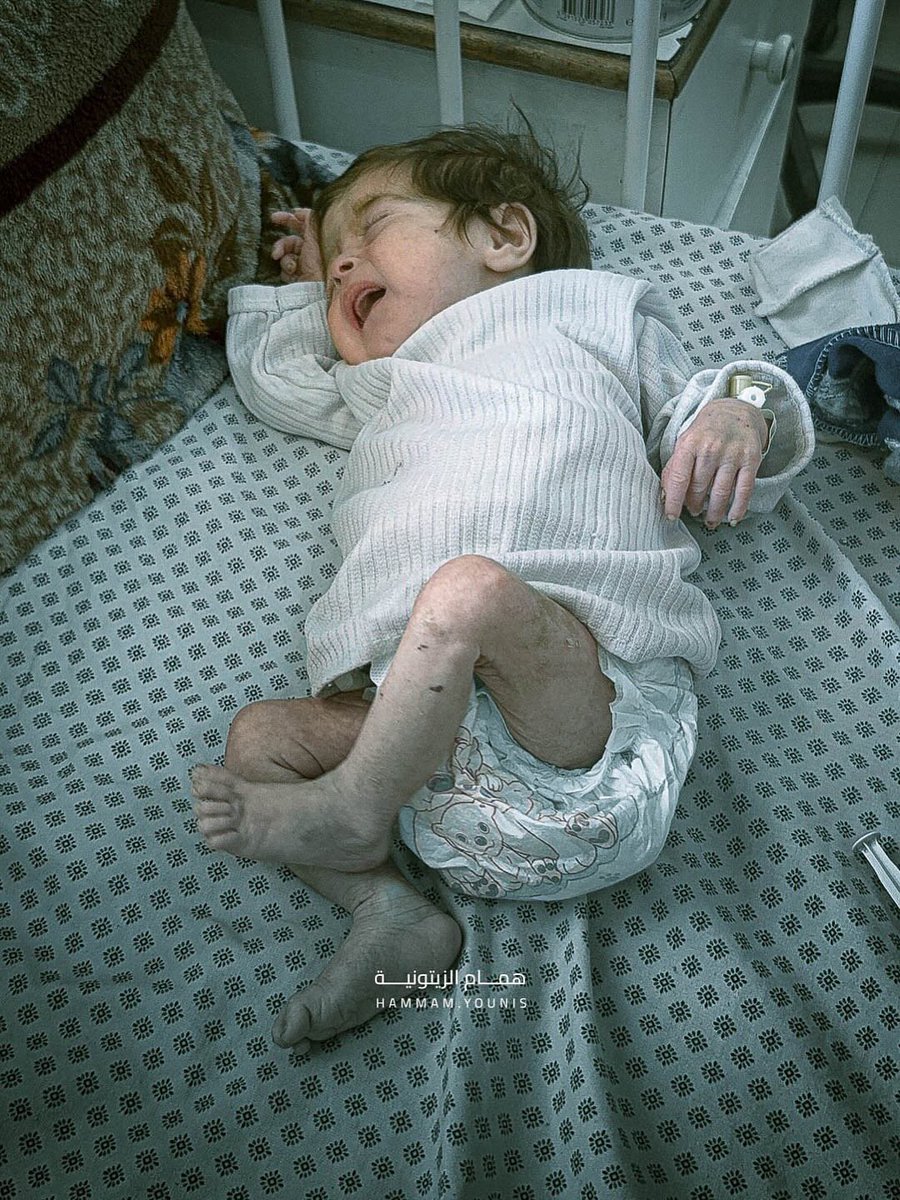 Lana is one of thousands of children in Gaza facing the threat of hunger and malnutrition under a suffocating blockade and severe shortages of food, water, and medicine.
Her frail body tells the story of a childhood drained behind a tent of displacement and beneath the rubble of
