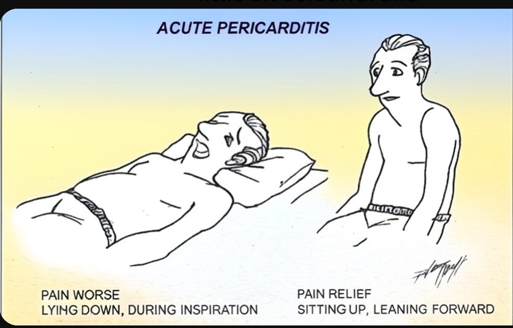 Acute pericarditis.