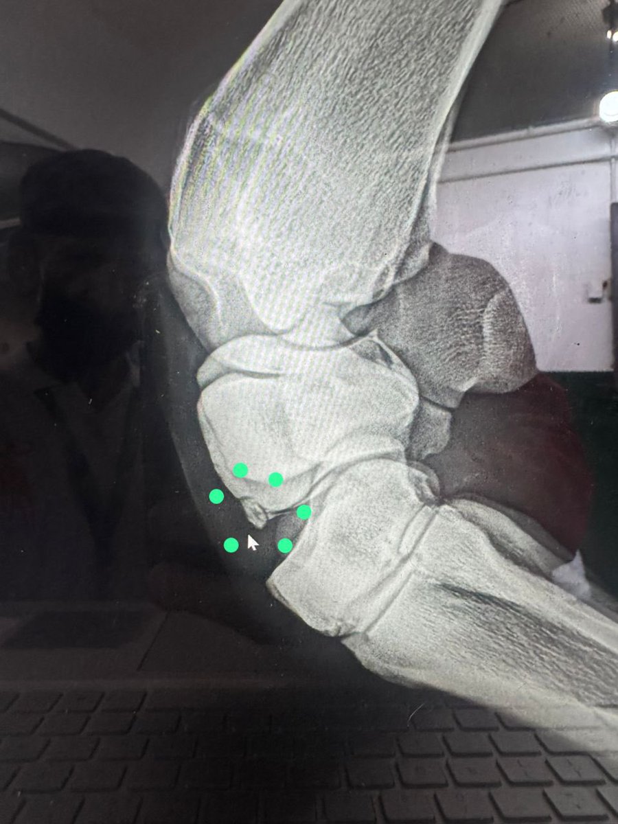 Riccardo D'Angelo (@rickydangelo13) on Twitter photo Le informo a toda la familia hípica que el ejemplar el relámpago será intervenido quirúrgicamente el día miércoles , presentó fractura en el carpo radial ! Estará fuera de cancha por 6 semanas!! <a href="/Gacetahipica/">Gaceta Hípica Oficial</a> <a href="/dimensionhipica/">Dimensión Hípica</a> <a href="/JLDangeloDuran/">Jose Luis D'Angelo Durán</a> <a href="/OficialINH/">OFICIAL INH</a> Le informo a toda la familia hípica que el ejemplar el relámpago será intervenido quirúrgicamente el día miércoles , presentó fractura en el carpo radial ! Estará fuera de cancha por 6 semanas!! <a href="/Gacetahipica/">Gaceta Hípica Oficial</a> <a href="/dimensionhipica/">Dimensión Hípica</a> <a href="/JLDangeloDuran/">Jose Luis D'Angelo Durán</a> <a href="/OficialINH/">OFICIAL INH</a>