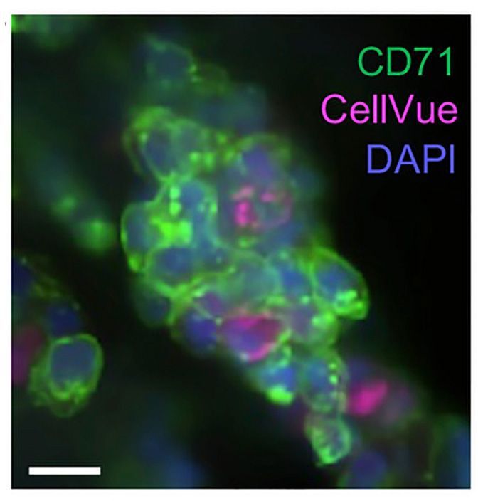 the_asci's tweet image. Ameliorating myeloproliferative neoplasms with cyclosporin A in preclinical models—
ASCI member Peng Ji & team @PengJi_lab @NUFeinbergMed discover PPIL2 as a target of the JAK2/STAT5 pathway that promotes myeloproliferation through p53 degradation: jci.org/articles/view/…