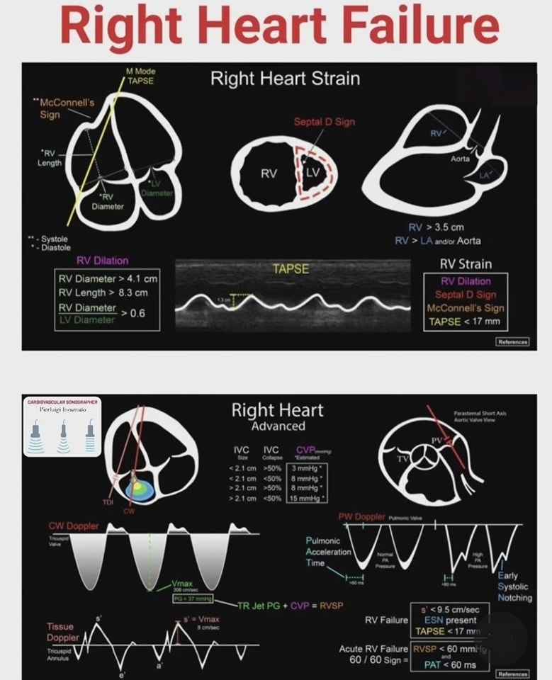 🔴Cardiac Ultrasound Pocket Cards⤵️ 
      ✅Right Heart Failure
    
     Available to download  FREE 
🔹pocus101.com/pocket-cards/
 #FOAMed #MedEd #medstudent #paramedic #Cardiology #CardioEd #medtwitter #meded #CardioTwitter #cardiotwiteros