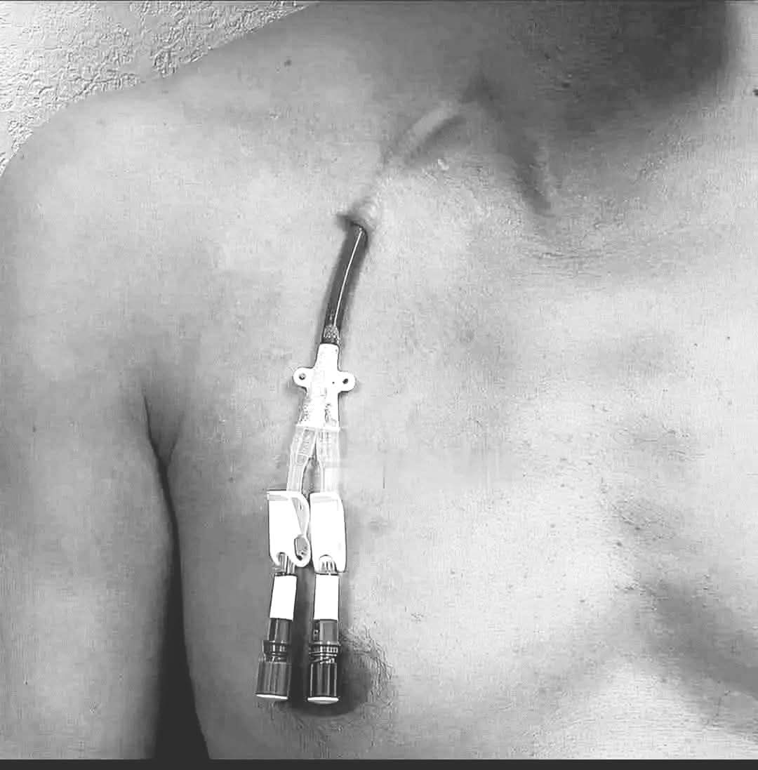এই ছবিটি একটি Central Venous Catheter (CVC) বা dialysis catheter-এর ছবি, যা সাধারণত বুকের উপরের অংশে (subclavian vein বা jugular vein দিয়ে) ঢুকিয়ে রক্ত পরিশোধন (dialysis) বা intravenous therapy দেওয়ার জন্য ব্যবহার করা হয়।