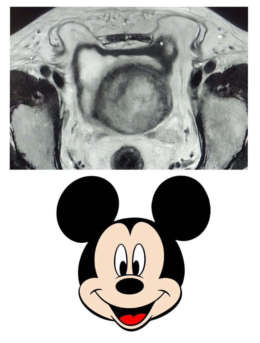 doc_tks_rad's tweet image. Bilateral Inguinal Hernia (direct) containing omental fat & anterolateral UB wall as contents- "Mickey Mouse sign" 🐭 on MRI
Ignore the partial volume of gross prostatomegaly!!
#FOAMrad #MickeyMouse