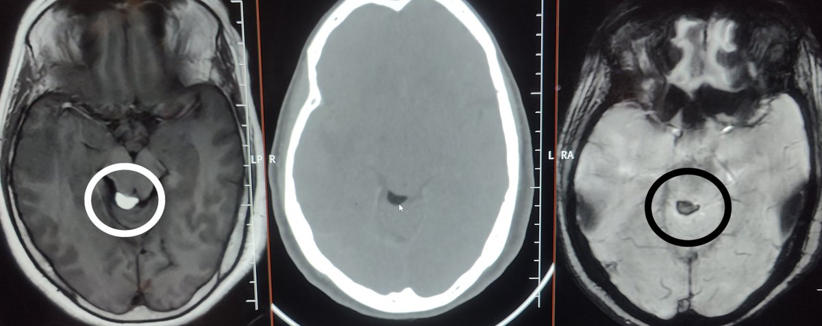 doc_tks_rad's tweet image. Quadrigeminal cistern lipoma
✅Intracranial lipomas show SWI blooming- but not due to blood products or Ca²+
✅SWI, highly sensitive to magnetic susceptibility differences➡️ fat can create local field inhomogeneities➡️ signal dropout/blooming at the edges (India ink artifact)!