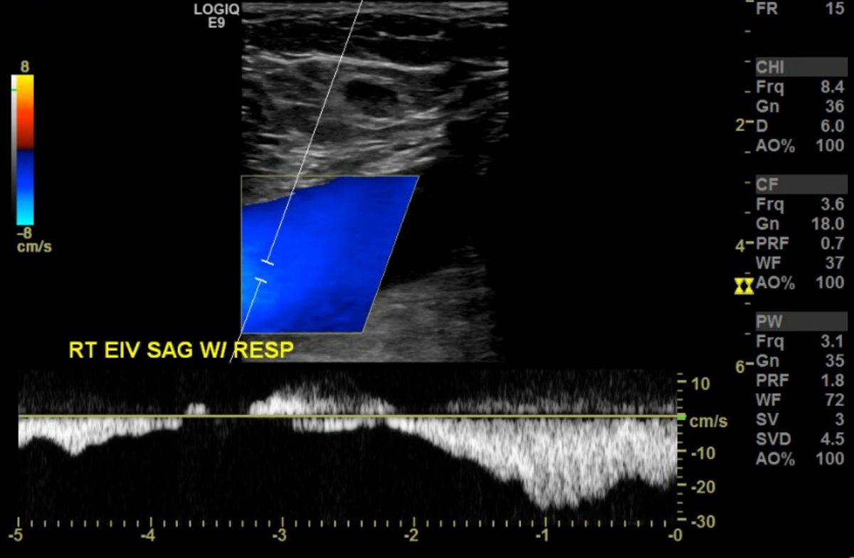 Robert Jones, DO (@rjonessonoem) on Twitter photo Featuredimage-On LE DVT-what is significance of phasic flow in the EIV? #POCUS #MedTwitter #Medstudent #MedicalEducation #ultrasoundeducation #ultrasound <a href="/NephroP/">NephroPOCUS</a> <a href="/ArgaizR/">Eduardo R Argaiz</a> <a href="/mount_md/">Cristin Mount, MD</a> <a href="/msiuba/">Matt Siuba</a> <a href="/TomJelic/">Tom Jelic</a> <a href="/thepocusatlas/">TPA</a> <a href="/cianmcdermott/">𝙲𝚒𝚊𝚗𝙼𝚌𝙳𝚎𝚛𝚖𝚘𝚝𝚝</a> <a href="/KalagaraHari/">🩺 Hari (హరి 🇮🇳) Kalagara</a> <a href="/kyliebaker888/">kylie baker</a> <a href="/dan___kim/">Dan Kim</a> <a href="/ACEP_EUS/">ACEP Ultrasound</a> Featuredimage-On LE DVT-what is significance of phasic flow in the EIV? #POCUS #MedTwitter #Medstudent #MedicalEducation #ultrasoundeducation #ultrasound <a href="/NephroP/">NephroPOCUS</a> <a href="/ArgaizR/">Eduardo R Argaiz</a> <a href="/mount_md/">Cristin Mount, MD</a> <a href="/msiuba/">Matt Siuba</a> <a href="/TomJelic/">Tom Jelic</a> <a href="/thepocusatlas/">TPA</a> <a href="/cianmcdermott/">𝙲𝚒𝚊𝚗𝙼𝚌𝙳𝚎𝚛𝚖𝚘𝚝𝚝</a> <a href="/KalagaraHari/">🩺 Hari (హరి 🇮🇳) Kalagara</a> <a href="/kyliebaker888/">kylie baker</a> <a href="/dan___kim/">Dan Kim</a> <a href="/ACEP_EUS/">ACEP Ultrasound</a>