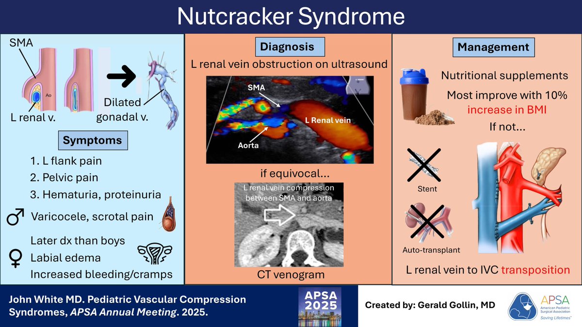 APSASurgeons's tweet image. Check out this visual abstract on nutcracker syndrome. #APSALearning