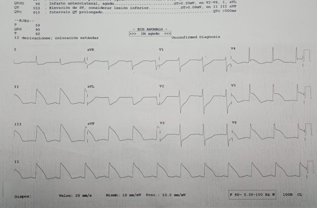 67 yo male, no heart disease history. During rhinoplasty patient suffered hypotension and was treated by anesthesiologist with epinephrine bolus, then this happened... Would you actívate cathlab? What could be happening? #EkgChallenge