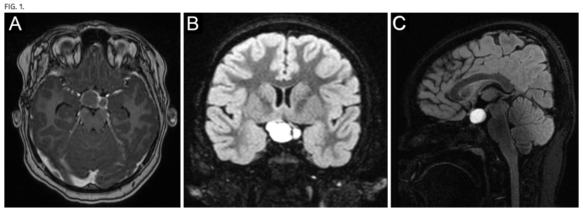 TheJNS's tweet image. #JNSCaseLessons. Authors discuss case of anaphylaxis after application of Tisseel fibrin sealant in the cavernous sinus during craniopharyngioma resection.
thejns.org/caselessons/vi…