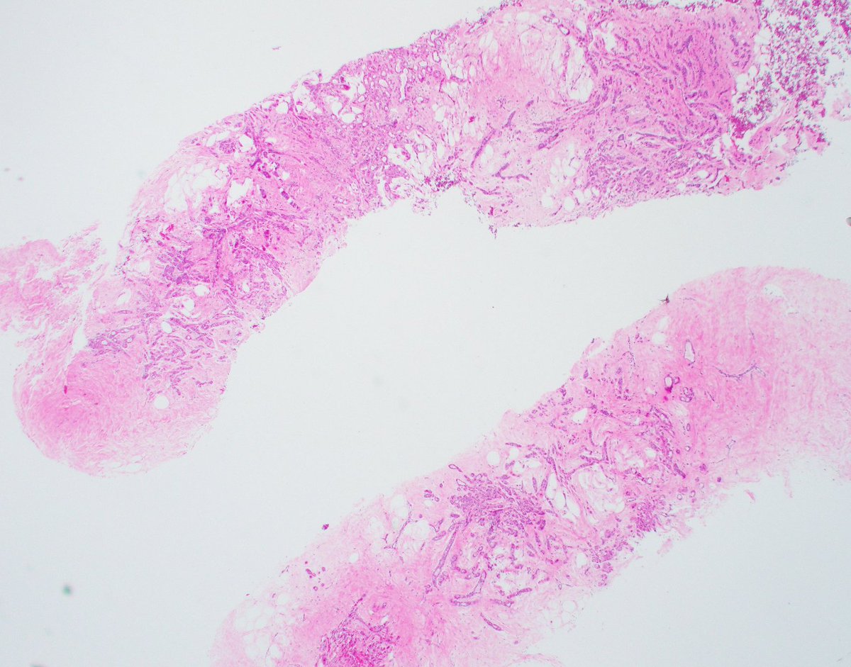 Beautiful example of irregular adenosis. Don't mistake it for invasion! #breastpath #PathTwitter