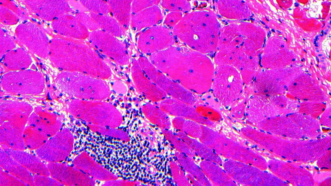 CleClinicMD's tweet image. A 45-year-old female who was diagnosed with juvenile myositis in the 1980s presented for further evaluation of inflammatory myositis.
She was referred to our Neuromuscular Medicine Clinic, where genetic testing corroborated a rare diagnosis.
More about the case:…