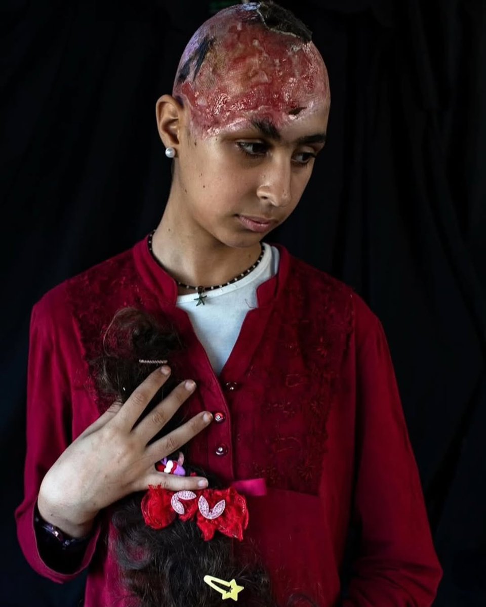 Twelve-year-old Hala Abu Dahleez possessed no weapon, only a swing, a braid, and a childhood that was taken from her far too soon. An airstrike irrevocably altered her life, the explosion not only tearing through her scalp and ripping out her hair but also inflicting wounds that