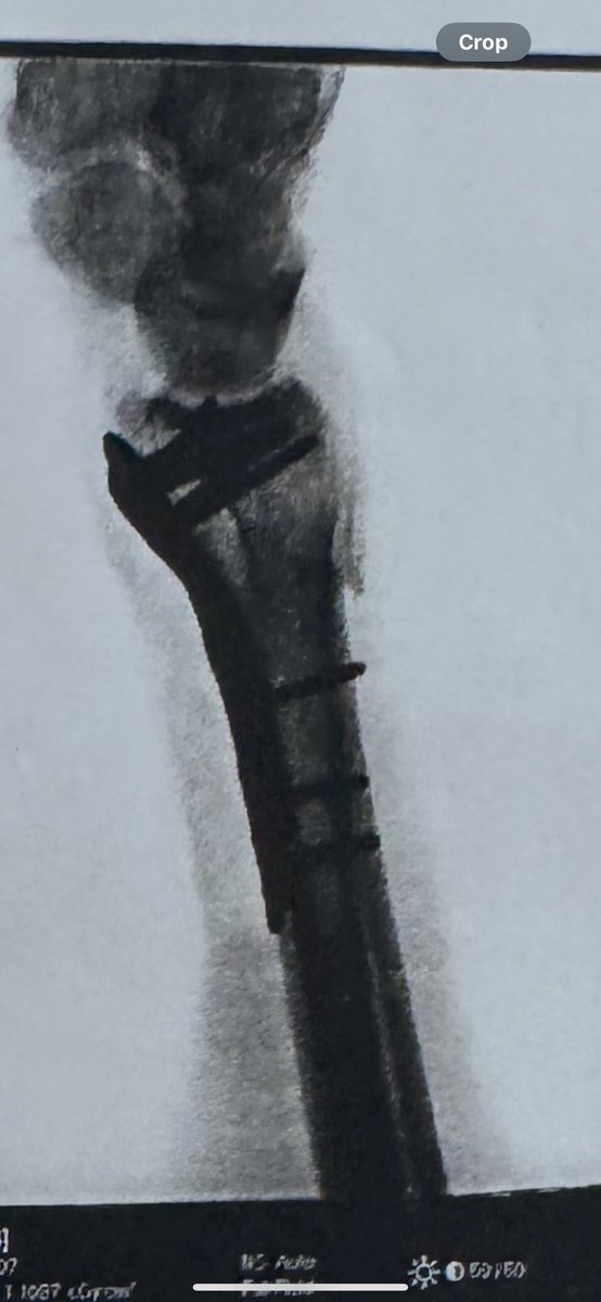 Operation successful. Back to gaming soon. Love you all, thanks for the support