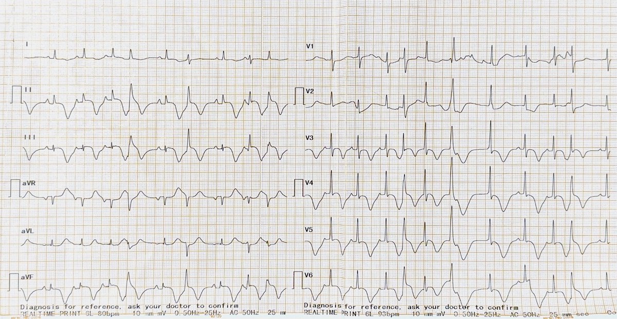 68 year old female with central chest pain of 4 hours duration, Trop positive