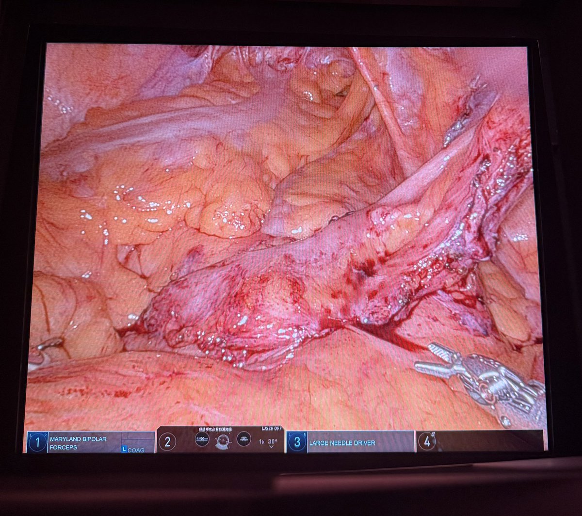 Final solution for this case. Right side distal stricture in Wallace anastomosis site. Redo a Bricker to avoid using new ileum.