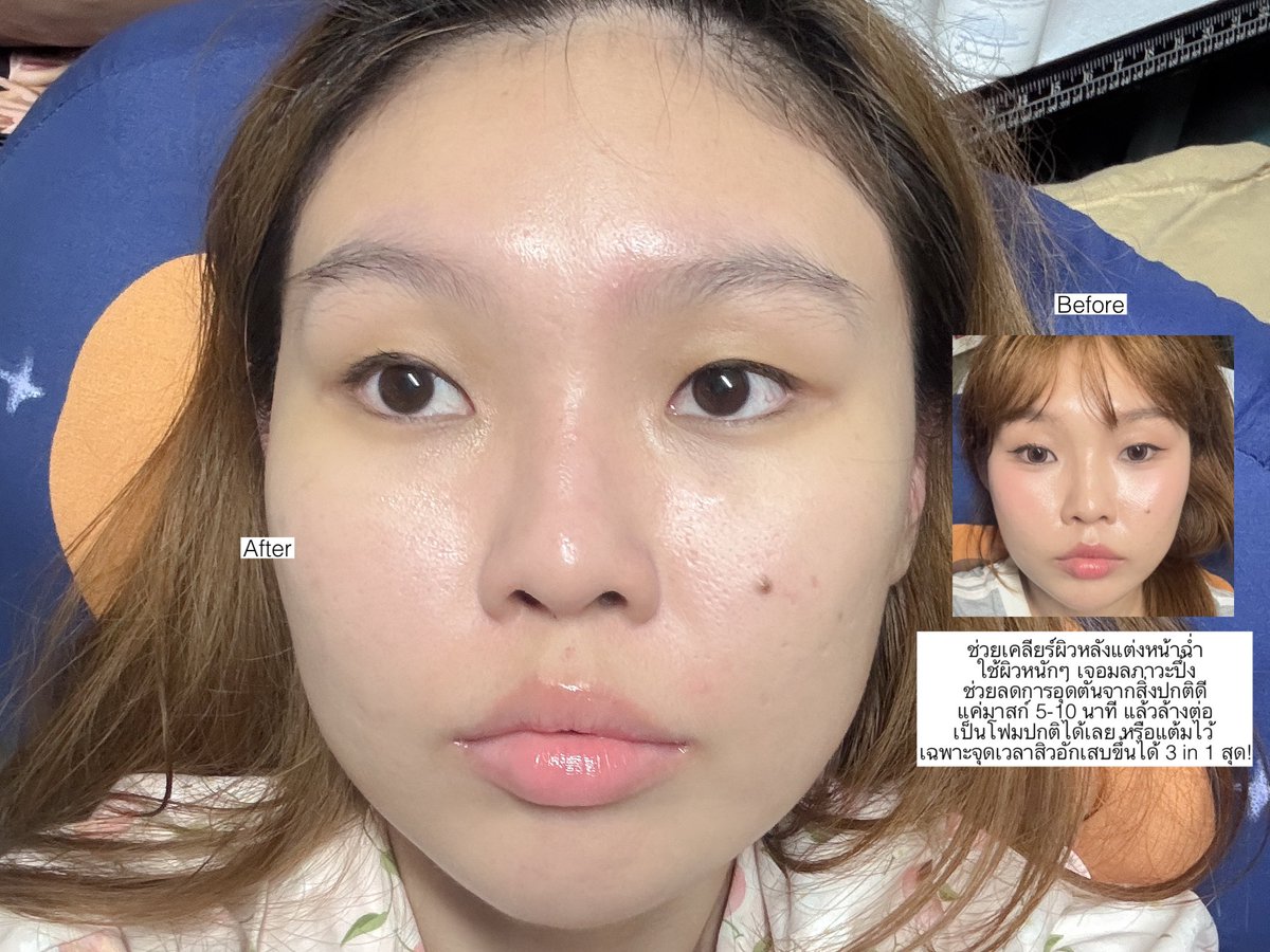 สิ่งใหม่ที่เกิดมาเพื่อชาวผิวอุดตันง่าย ไม่เคยคาดหวังแต่ดีกว่าที่คิด เราชอบใช้ช่วงที่หลังแต่งหน้า+เจอมลภาวะหนักๆมา มันเคลียร์ผิวดึงสิ่งสกปรกออกดีมากอะ สังเกตไม่ค่อยมีสิวอุดตันหลังแต่งหน้าเลย เราจะมาสก์ไว้ 5-10 นาที แล้วนวดเป็นโฟมต่ออีก 1 นาที จบบบ