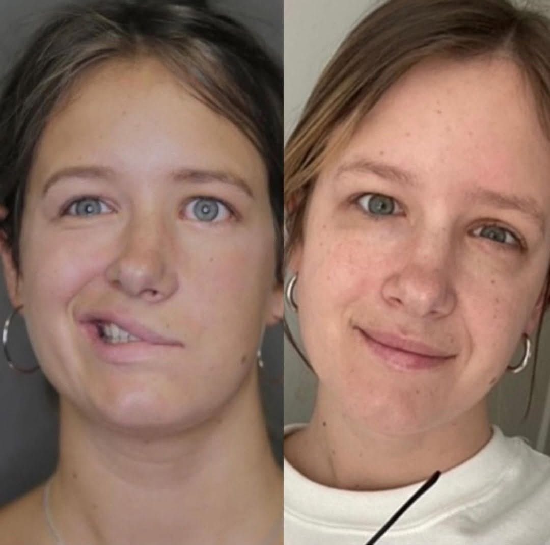NewYorkFPC's tweet image. We love sharing Loren's before and after photos!

Loren struggled with facial paralysis following emergency brain tumor surgery. Dr. O and the specialists at New York Facial Paralysis helped her get her smile back!

#newyorkfacialparalysis #facialparalysis #braintumor