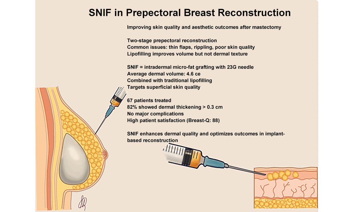 PARjournal's tweet photo. 🚨 New insights in #breast #reconstruction!
Sharp-needle intradermal fat grafting (SNIF) shows promise in enhancing aesthetics &amp; reducing complications in two-stage prepectoral breast reconstruction after mastectomy.
🤵Dr. Ishith Seth's team
🔗https://t.co/eJTg0sFiF3 https://t.co/eno4Rhih9U