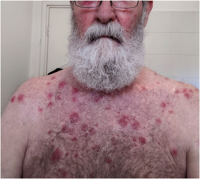 AJDP_Journal's tweet photo. #WhatsNewInDermpath
Histiocytoid sweet syndrome as a manifestation of myelodysplasia cutis/cutaneous VEXAS Syndrome

73YM with myelodysplastic syndrome presented with an acute eruption of erythematous violaceous &amp; indurated dermal nodules and plaques

Figure 3: (A) CD163, (B) MPO https://t.co/UIdcK3GCHb