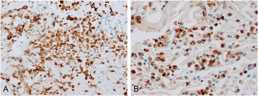 AJDP_Journal's tweet photo. #WhatsNewInDermpath
Histiocytoid sweet syndrome as a manifestation of myelodysplasia cutis/cutaneous VEXAS Syndrome

73YM with myelodysplastic syndrome presented with an acute eruption of erythematous violaceous &amp; indurated dermal nodules and plaques

Figure 3: (A) CD163, (B) MPO https://t.co/UIdcK3GCHb