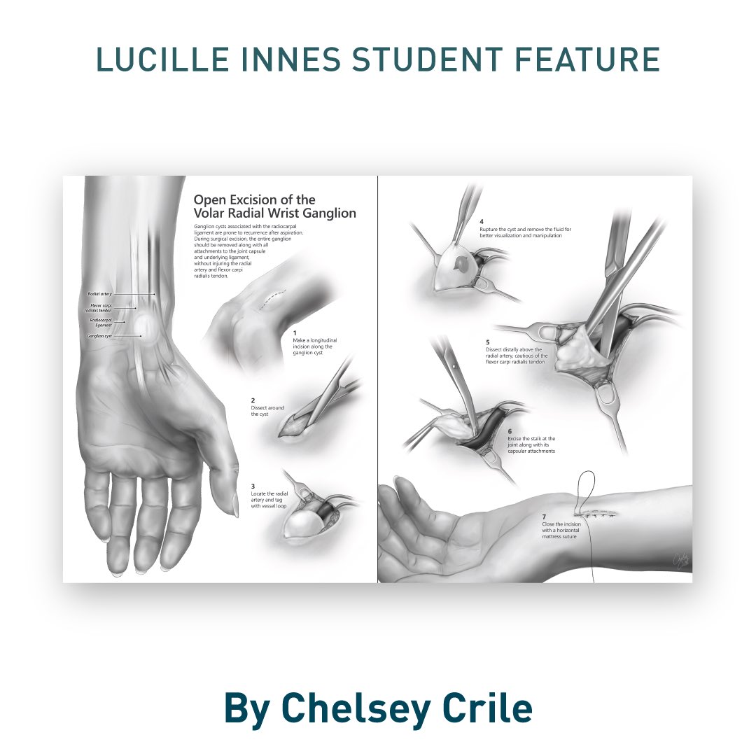 Introducing Chelsey Crile, featured student presenter, at the #VesaliusTrust Lucille Innes Student Showcase on Fri, July 18, 2025 (3:00–4:30 pm) at the <a href="/AMIdotorg/">AMI</a> annual mtg in Grand Rapids, MI. Stop by, meet the recent grads &amp; see what they have been working on. #medart #sciart