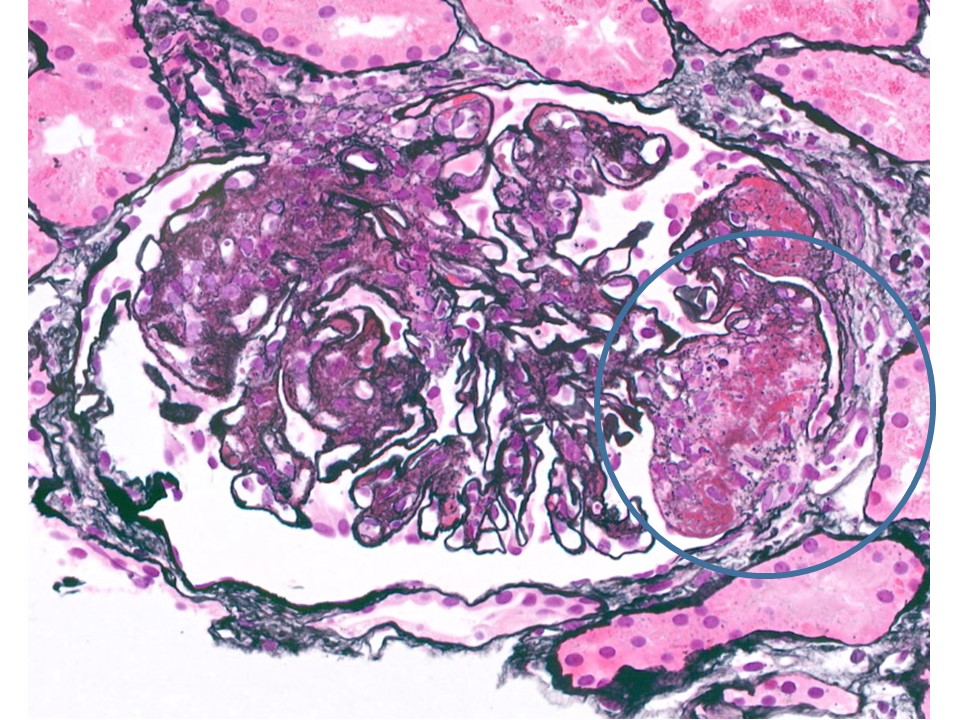Biopsy from a patient with lupus nephritis class IV+V. What is the lesion in circle?