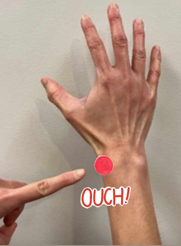Did you know?🤔

For De Quervain’s Tenosynovitis 👍 patient perspectives 🟰imp since personal choice can vary between therapy, splint, injection &amp; surgery! 👀

jhsgo.org/article/S2589-…

Educating on the various interventions available should be part of a clinician’s approach 👌👌