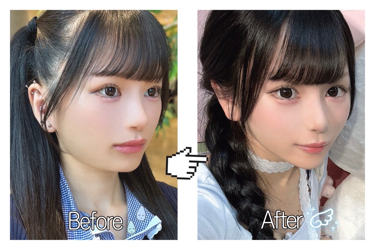 えっかなり良い感じにフェイスライン整ってきてない⁉️術後10日‼️(何の施術したでしょう？)