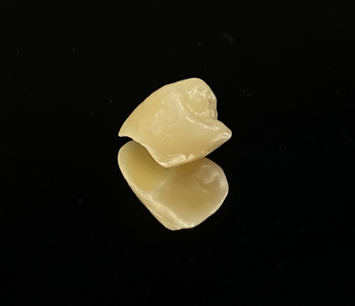 TheLabProtesis's tweet image. Ayer le tomamos fotos a una corona en circonio acabada y lista para colocar!

¿Quieres contratar nuestros servicios? No dudes en llamar al 913-230-700.