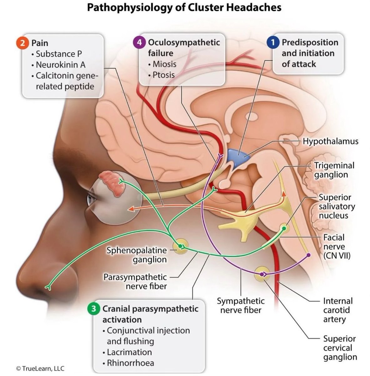 OGdukeneurosurg's tweet photo. Cluster headaches https://t.co/BQkuhOiiNJ