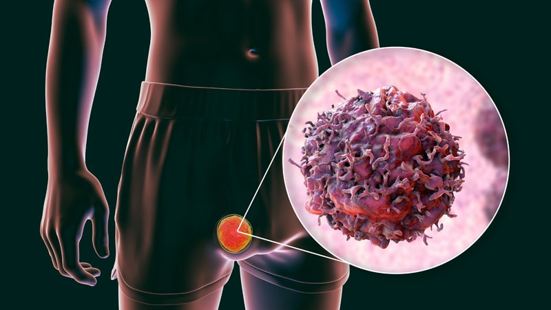 Guidelines in Practice from Medscape (@ginp_medscape) on Twitter photo When a Giant Scrotum Imitates a Germ Cell Tumour
ms.spr.ly/6011S2iaz When a Giant Scrotum Imitates a Germ Cell Tumour
ms.spr.ly/6011S2iaz