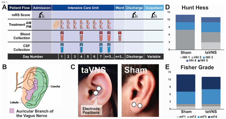 TheJNS's tweet image. #FreeArticle. Authors highlight randomized controlled trial evaluating modulatory effects of transauricular vagus nerve stimulation on inflammatory response and vasospasm following subarachnoid hemorrhage.
thejns.org/view/journals/…