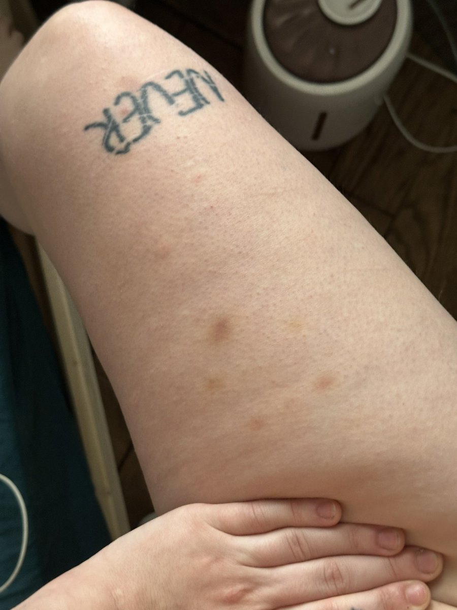 бабьи синячки (girl’s bruises)