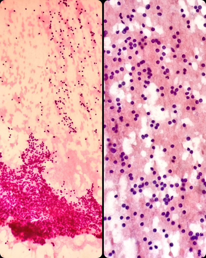 🖥️ Right thyroid nodule.  Isoechoic.  Ill-defined.
💉 Ultrasound guided fine needle aspiration performed by Interventional Pathologist.
1️⃣ Pass.  25g, 1.5cm.
🔬 Bethesda II.  Lymphocytic Thyroiditis.

#Cytology #CytoPath #PathX