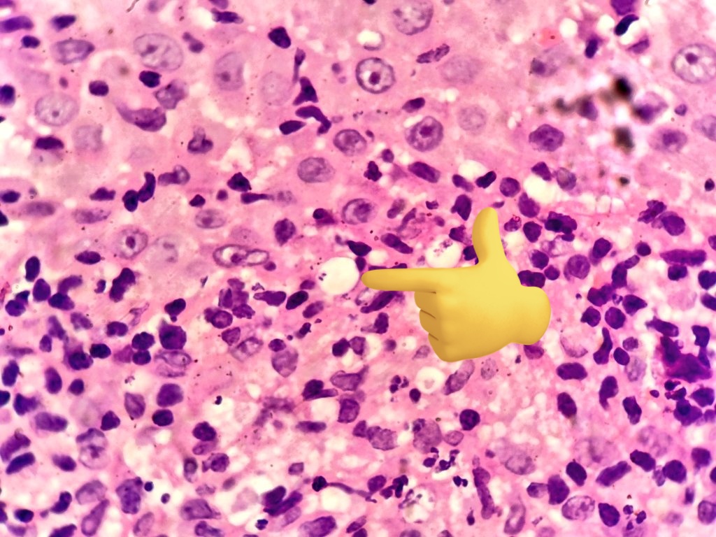 padmapathology1's tweet image. #dermpath 
#IDpath 
#pathtwitter 
Ulcer in the forearm
Diagnosis? 
Please vote in the poll below ⬇️⬇️