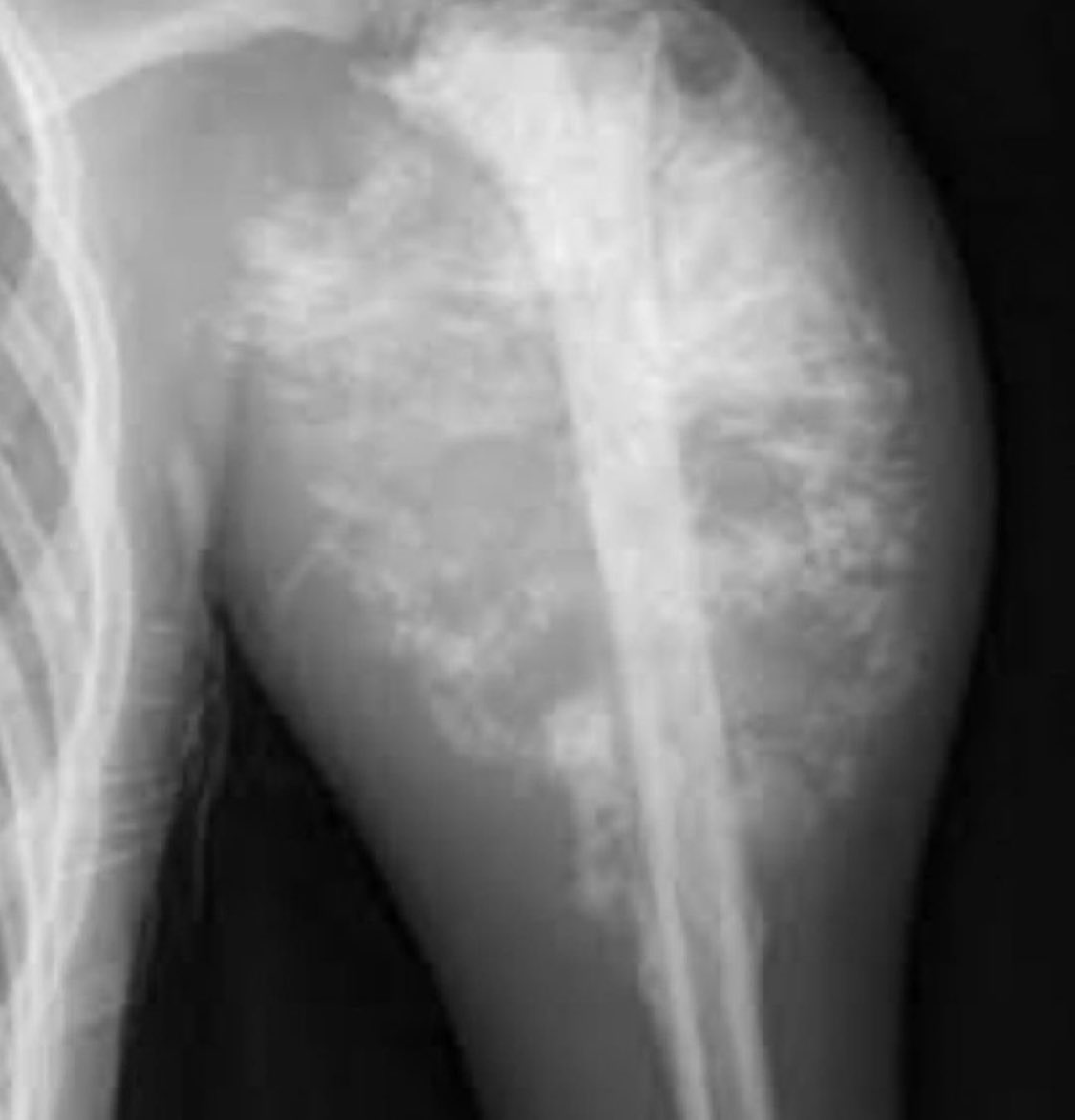 Doctors__squad's tweet photo. Patient presents with bone pain, swelling, weight, loss, and anemia. X-ray showed the following. What is your diagnosis? https://t.co/k6ypmPQDL3