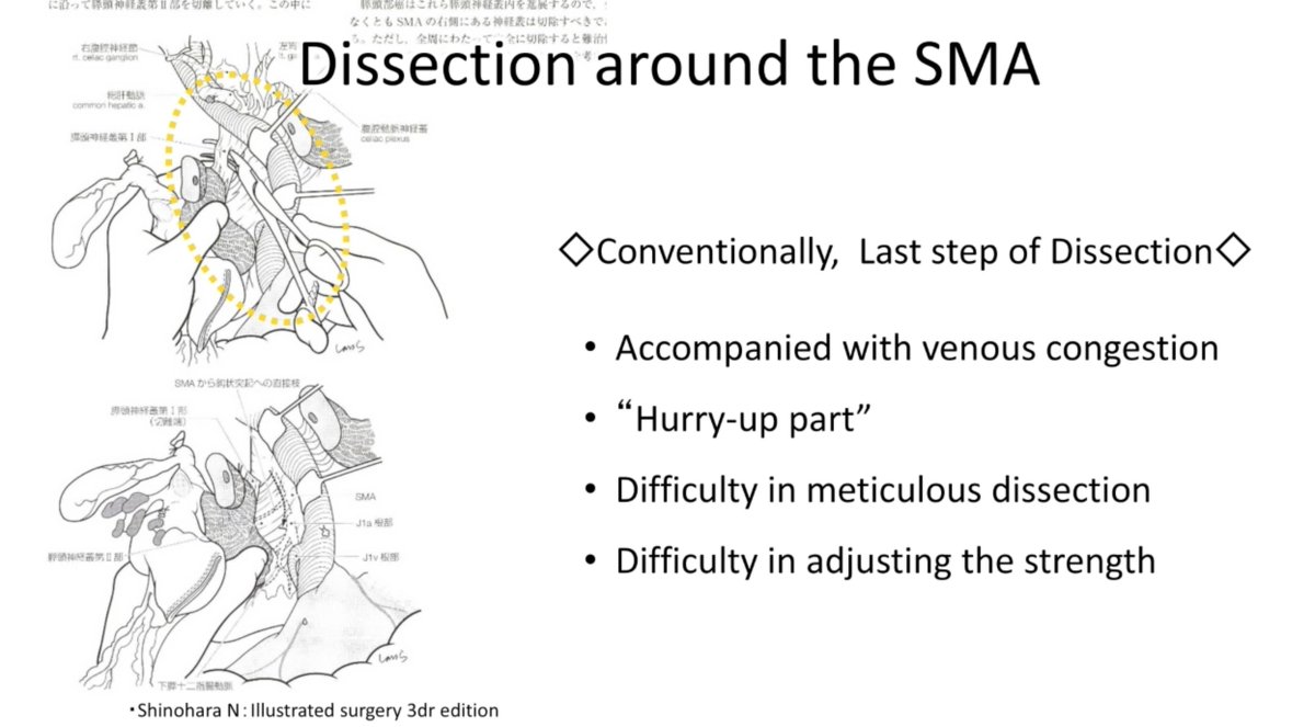 EAVegaMD's tweet image. 🎥 New #HowIDoIt video from @SSATNews 
@YosukeInoueHPB and team showcase their open &amp;amp; 🤖 PD with an SMA-🥇 approach – enhancing safety and oncologic outcomes in panc surgery.
Watch now ➡️ ssat.com/video/robotic.…
@AHPBA @EAHPBA @JSHBPS @chiaro_del @KenichiroUemura @ObaAtsushi…