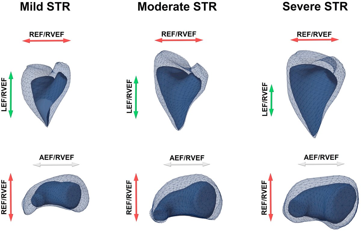 Data regarding right ventricular mechanical adaptation to secondary tricuspid regurgitation are scarce.

We investigated changes in RV contraction pattern in patients with different degrees of STR severity &amp; etiologies &amp; their association with outcomes. bit.ly/4kCFuly