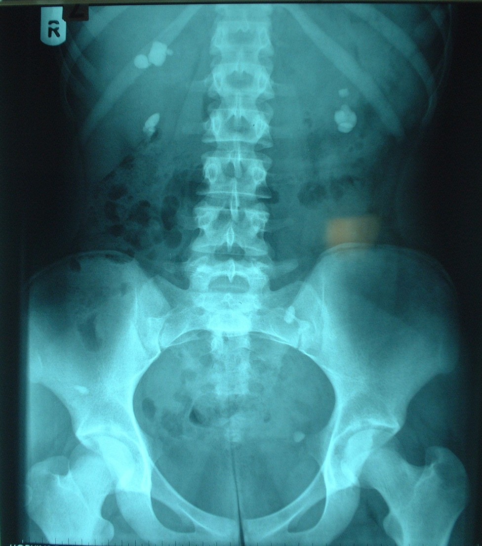 New research results into kidney stones🎉

Professor Sarah Howles, and her team, have discovered DNA changes that likely control people’s calcium and phosphate levels and cause kidney stones. 

Treating patients with existing drugs and supplements that affect calcium and