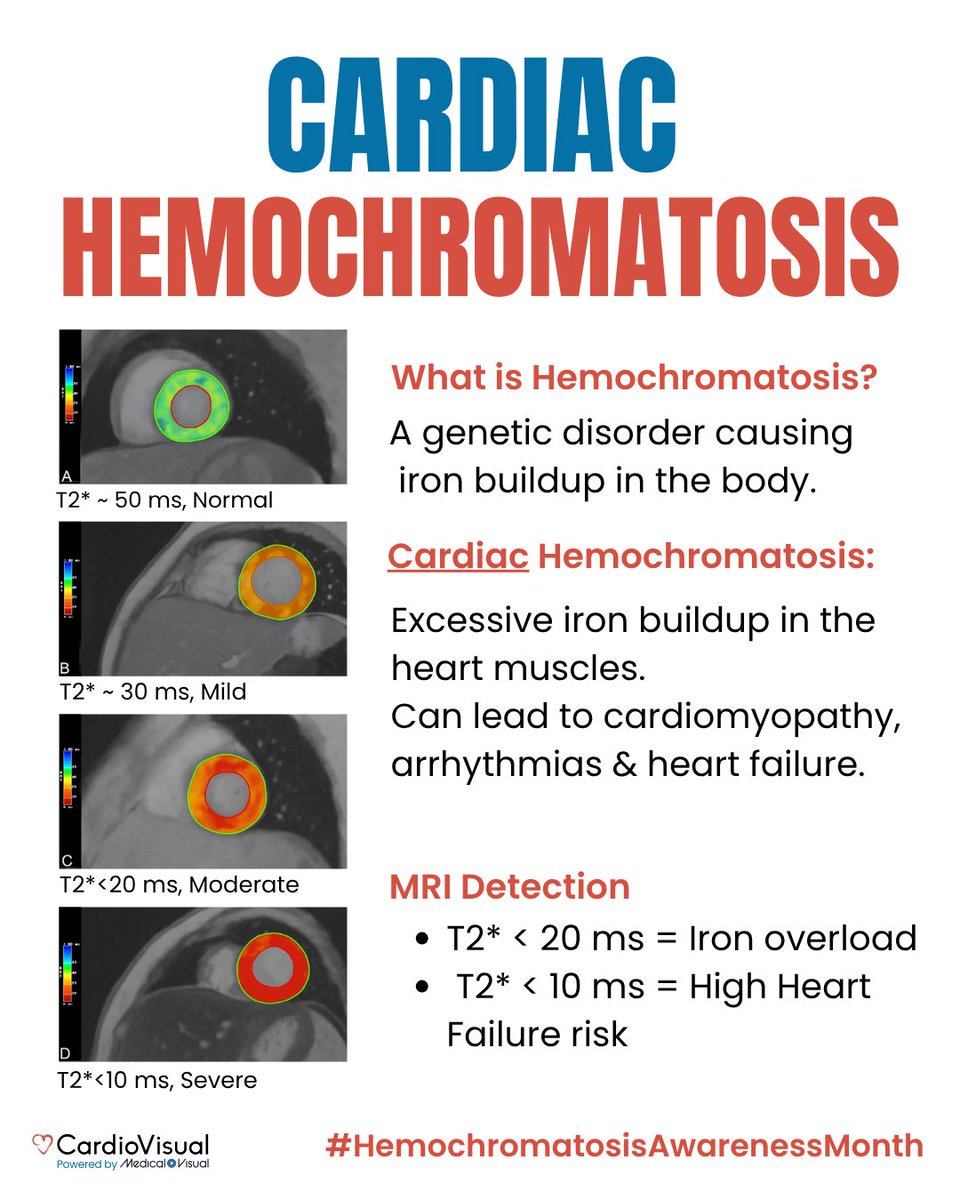 CardioVisualApp's tweet image. Hemochromatosis can lead to cardiac iron overload, causing arrhythmias, fatigue &amp; heart failure. Cardiac MRI detects iron buildup early, even before ECG changes.
#HemochromatosisAwarenessMonth #CardiacMRI #HeartHealth