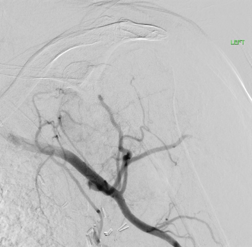 NaineshParikhMD's tweet image. 68 yo woman with breast cancer and progressive adhesive capsulitis - my friend and colleague @alroubaieMD performed what might be the tampa region’s first adhesive capsulitis embo!
nice technical outcome! she should do well!
@MoffittNews
#irad
