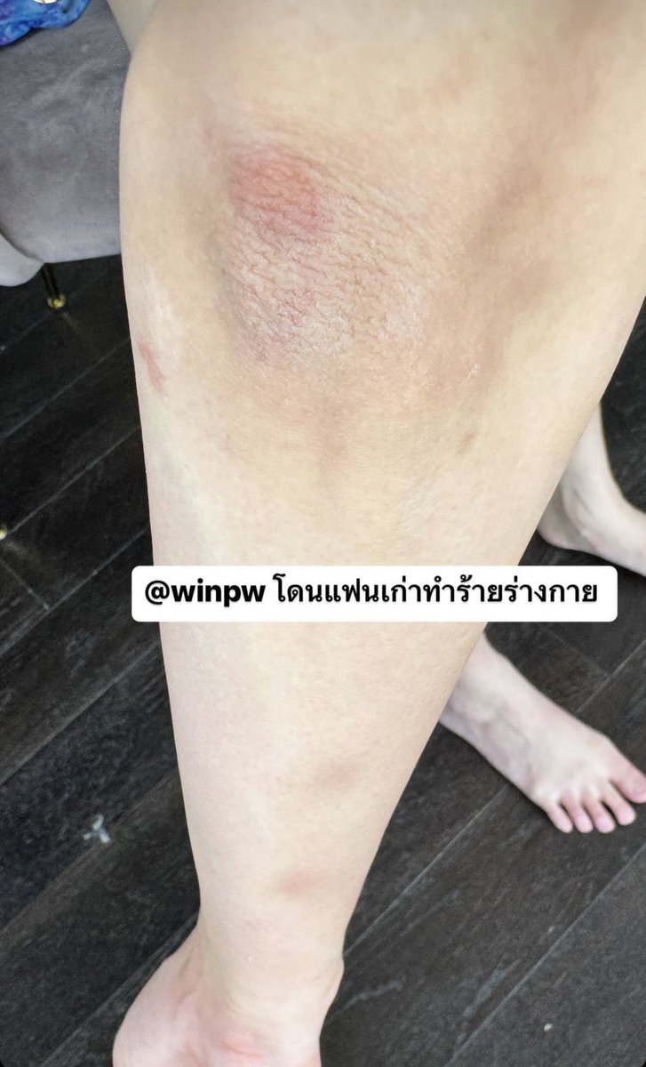 tw physical abuse //
 
reminder that pawin literally put his ex in the hospital and there is photographic evidence to back it up since gmmtv seems to keep forgetting

this is what they are promoting, this is what they’re willing to let slide to protect him