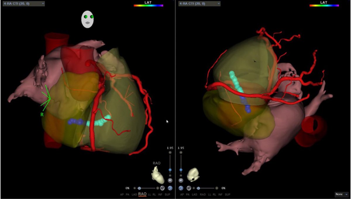 #EPeeps

Ablation of cavo-tricuspid isthmus dependent atrial flutter using a focal monopolar pulsed-field ablation catheter: Feasibility, periprocedural coronary spasms and conduction disorders.

✴️84 patients from 2 large EP centers…

👉🏻For focal #PFA vs #RFA radiofrequency:
-